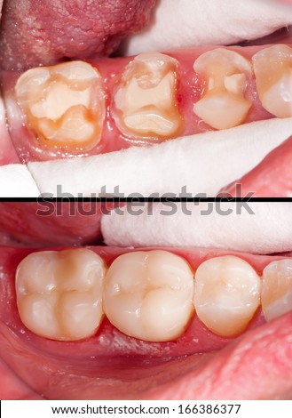Tooth restoration before and after dental treatment Royalty-Free Stock Photo #166386377