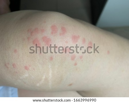 The picture of erythematous rash,itch on human ankle and leg is call urticaria. Medical and education concept.