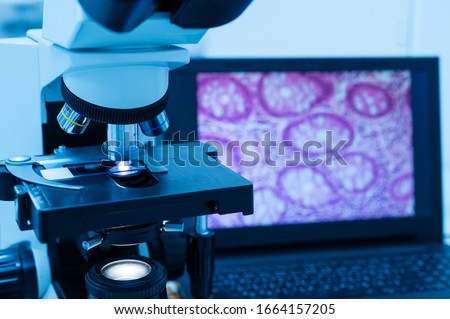 Modern microscope and human tissue section slide with computer monitor show glandular image.Medical patholology and cytologytechnology concept.Selective focus.