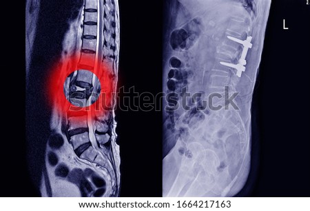 Medical X-ray and MRI of lumbar spine compression fracture Bulging of L1-2.and post lumbar spine  fix by iron rod and screws.Lumbar spondylosis from L1-2 to L5-S1 discs.Medical healthcare concept.
