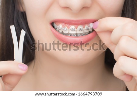 Applying orthodoentic wax on the dental braces. Brackets on the teeth after whitening. Self-ligating brackets with metal ties and gray elastics or rubber bands for perfect smile. Royalty-Free Stock Photo #1664793709