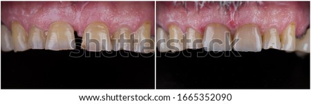 before and after picture for dental treatment, natural press ceramic crowns