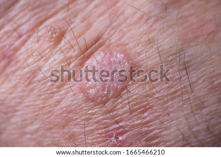 Crude eczema with redness, swellings, bumps and flakes on the wrist of a man. Actinic keratosis. This can be treated with cryosurgery or certain ointments Royalty-Free Stock Photo #1665466210