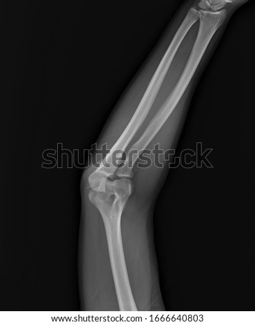 x- ray of the elbow joint, diagnosis of bone fractures