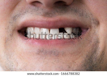 Close Up Photo Of Young Man With Missing Tooth Royalty-Free Stock Photo #1666788382