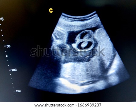 fetal hydrocele testis by ultrasound Royalty-Free Stock Photo #1666939237
