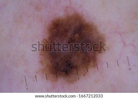 Dermatoscopic picture of melanoma - a malignant tumor from a mole