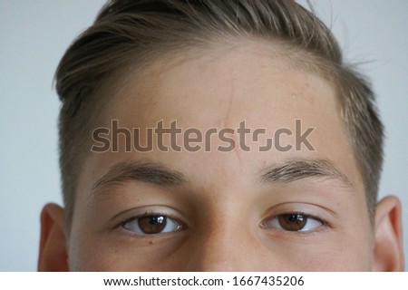 Teenager's forehead close up, young skin imperfection scar and acne Royalty-Free Stock Photo #1667435206