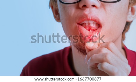 Asian man have aphthous ulcers on mouth on white background, selective focus. Royalty-Free Stock Photo #1667700877