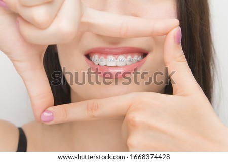 Dental braces in happy womans mouths through the frame. Brackets on the teeth after whitening. Self-ligating brackets with metal ties and gray elastics or rubber bands for perfect smile. Orthodontic Royalty-Free Stock Photo #1668374428
