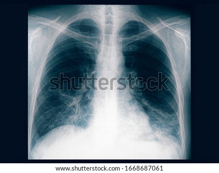 Xray of the lungs of an adult male with bilateral pneumonia. Royalty-Free Stock Photo #1668687061