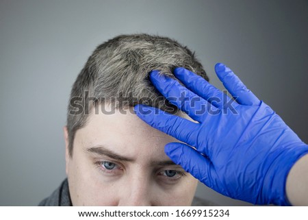A trichologist examines a young man’s gray hair under a magnifying glass. Earlier bleaching of hair and pigment as a sign of low melanin in a guy’s body