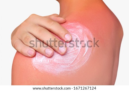 A man with reddened, itchy skin after sunburn. Skin care and protection from the sun's ultraviolet rays. Cosmetology concept