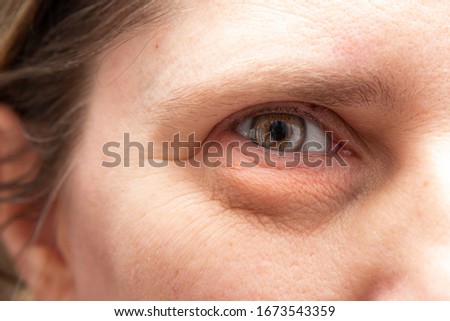 Closeup of wrinkles and heavy puffiness in the eye region of a middle aged woman. Plastic surgery concept Royalty-Free Stock Photo #1673543359