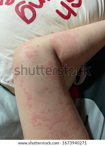 The picture of erythematous rash,itch on human leg is call urticaria. Medical and education concept.