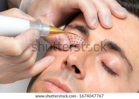 Close up macro detail of middle aged man having skin tightening on eyelids with laser plasma pen. Royalty-Free Stock Photo #1674047767