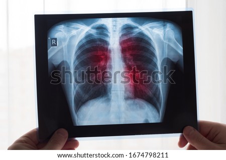 Lung radiography concept. Radiology doctor examining at chest x ray film of patient Lung Cancer or Pneumonia. Virus and bacteria infected the Human lungs. Patient with Lung Cancer or Pneumonia.