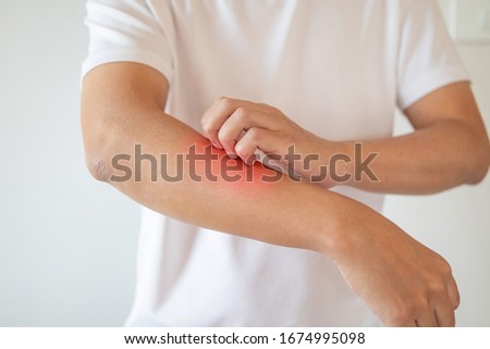 man itching and scratching on arm from itchy dry skin eczema dermatitis Royalty-Free Stock Photo #1674995098