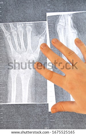 X-ray picture of a broken hand
