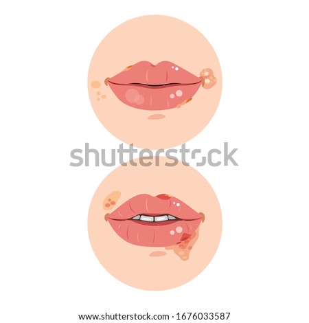 Woman's face with virus herpes on lip. Royalty-Free Stock Photo #1676033587