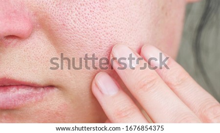 Macro skin with enlarged pores. The girl touches the irritated red skin with her fingers. Royalty-Free Stock Photo #1676854375