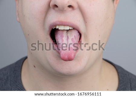 White curd on the tongue. A physician or gastroenterologist examines a man’s tongue. Patient has poor oral hygiene or a symptom of illness