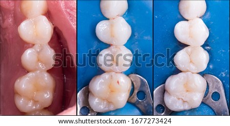 tooth direct restoration before and after picture