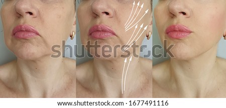 woman face wrinkles   after treatment, thread lifting Royalty-Free Stock Photo #1677491116