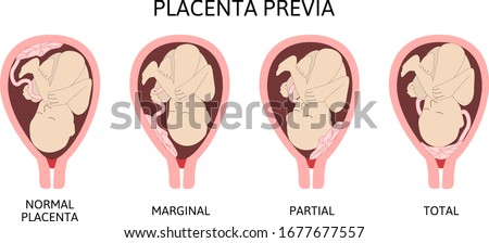 PLACENTA-PREVIA Stock Vector Images - Avopix.com