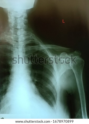 X-ray film of middle-aged women with left shoulder pain Because the tendon is inflammation from calcific tendinitis And calcific clinging to the shoulder bones.
 Royalty-Free Stock Photo #1678970899
