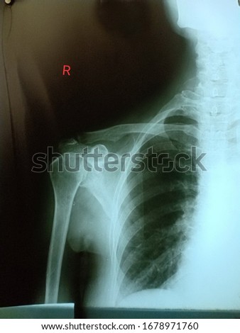 X-ray film of middle-aged women with right shoulder pain Because the tendon is inflammation from calcific tendinitis And calcific clinging to the shoulder bone Royalty-Free Stock Photo #1678971760