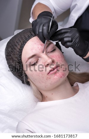 Beautician make procedure for cleaning skin with steel tool from blackheads and acne in cosmetology center. Acne treatment. Cosmetology and professional skin care.