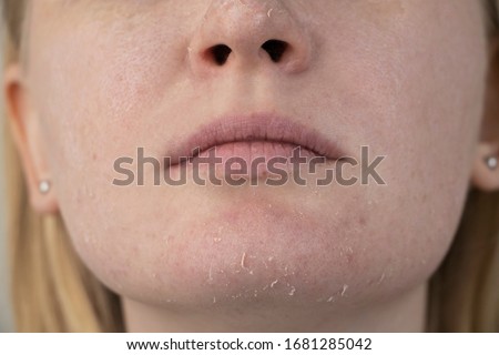 A woman examines dry skin on her face. Peeling, coarsening, discomfort, skin sensitivity. Patient at the appointment of a dermatologist or cosmetologist, selection of cream for dryness Royalty-Free Stock Photo #1681285042