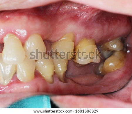 Dental Cervical abfraction is a theoretical concept explaining a loss of tooth structure not caused by tooth decay (non-carious cervical lesions). Royalty-Free Stock Photo #1681586329