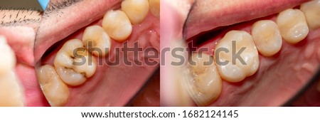 Dental caries. Filling with dental composite photopolymer material using rabbders. The concept of dental treatment in dental clinic Royalty-Free Stock Photo #1682124145