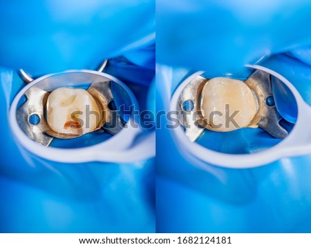 Dental caries. Filling with dental composite photopolymer material using rabbders. The concept of dental treatment in dental clinic Royalty-Free Stock Photo #1682124181