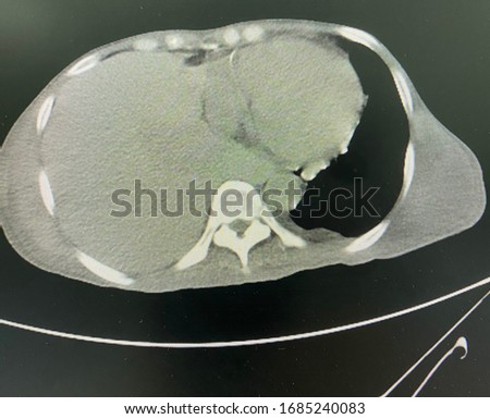 The picture of Computerized Tomography Scan of patient who have massive right pleural effusion. Horizontal view.Medical educational concept.