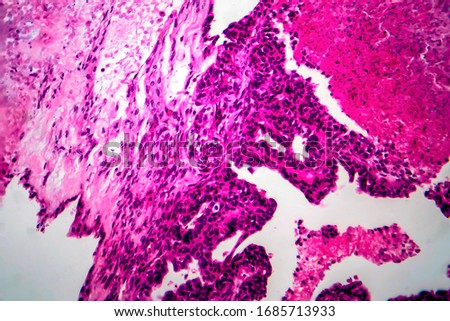 Papillary serous ovarian adenocarcinoma, cancer of ovary, light micrograph, photo under microscope