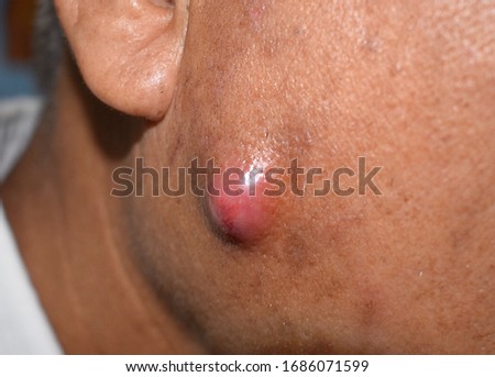 Painful, large abscess resulting from acne or Staphylococcal / Streptococcal skin infection in face of Southeast Asian Burmese adult male patient in clinic of Myanmar. Closeup view. Royalty-Free Stock Photo #1686071599