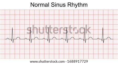 Electrocardiogram show normal heart beat line (Sinus rhythm). ECG. EKG. Vital sign. Medical healthcare symbol. Royalty-Free Stock Photo #1688917729