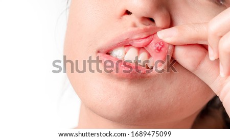 Asian women have aphthous ulcers on mouth on white background, selective focus. Royalty-Free Stock Photo #1689475099