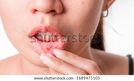 Asian women have aphthous ulcers on mouth on white background, selective focus. Royalty-Free Stock Photo #1689475105