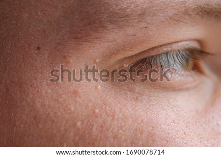 Milia (Milium) - pimples around eye on skin. Eyes of young man with small papillomas on eyelids or growths on skin. Face closeup.  Royalty-Free Stock Photo #1690078714