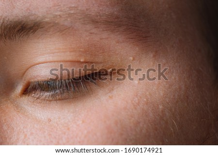 Milia (Milium) - pimples around eye on skin. Eyes of young man with small papillomas on eyelids or growths on skin. Face closeup.  Royalty-Free Stock Photo #1690174921