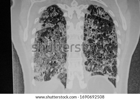 Chest CT Scan of novel Coronavirus COVID-19. Ground Glass opacities, crazy-paving, adenovirus pneumonia shows bilateralmultifocal GGO with patchy consolidations on CT image. May show lower or segmenta Royalty-Free Stock Photo #1690692508