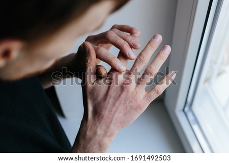 Man with sick hands, dry flaky skin on his hand with vulgar psoriasis, eczema and other skin diseases such as fungus, plaque, rash and blemishes. Autoimmune genetic disease. Royalty-Free Stock Photo #1691492503