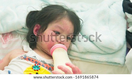 Asian girl with rash from milk allergy. Royalty-Free Stock Photo #1691865874