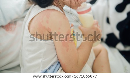 Asian girl with rash from milk allergy. Royalty-Free Stock Photo #1691865877
