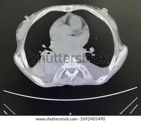 The picture of Computerized Tomography Scan of patient who have right mediastinal mass.Horizontal view.Medical educational concept.