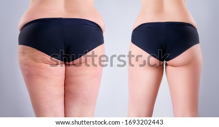 Overweight woman with fat legs and buttocks, before after weight loss concept, obesity female body on gray background
